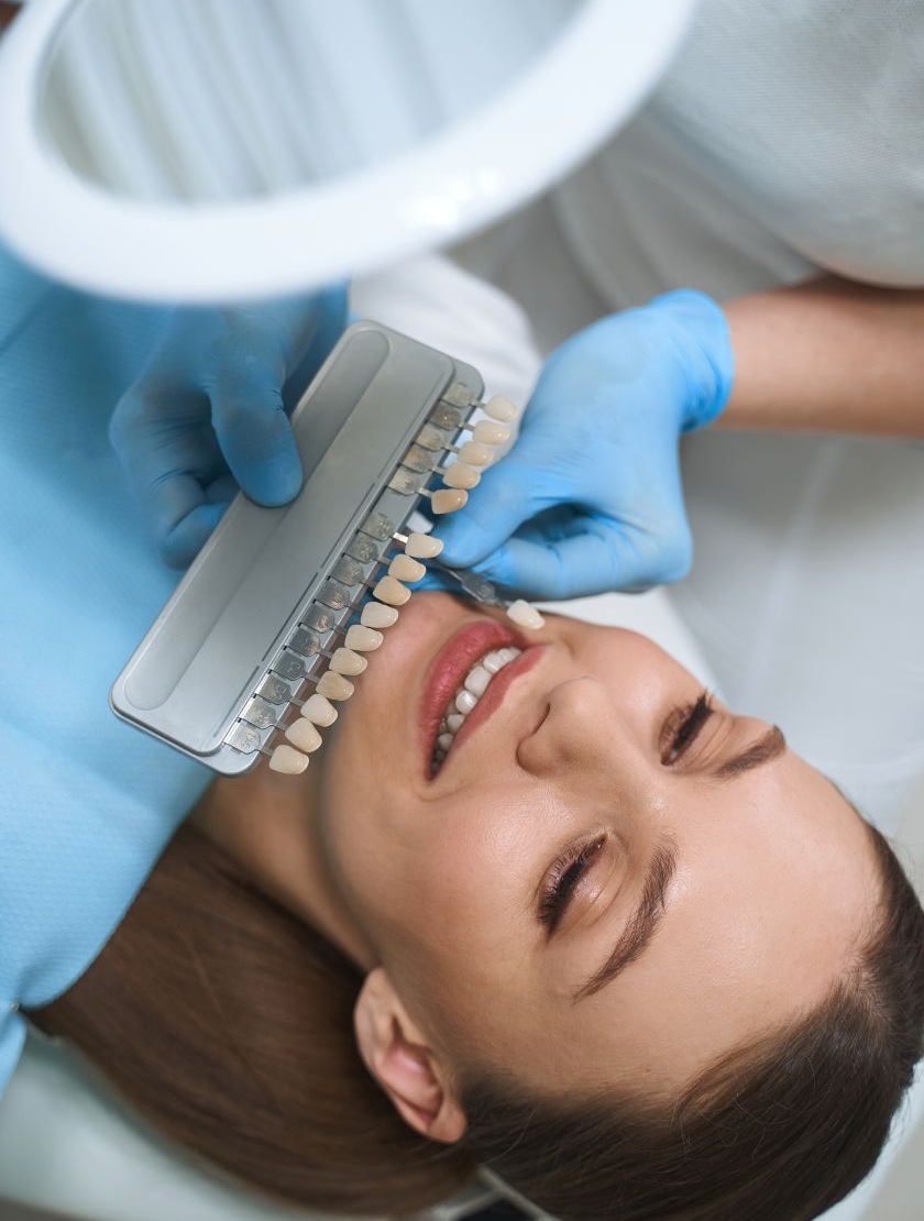 Mock-up and shade selection – Hollywood Smile in Istanbul