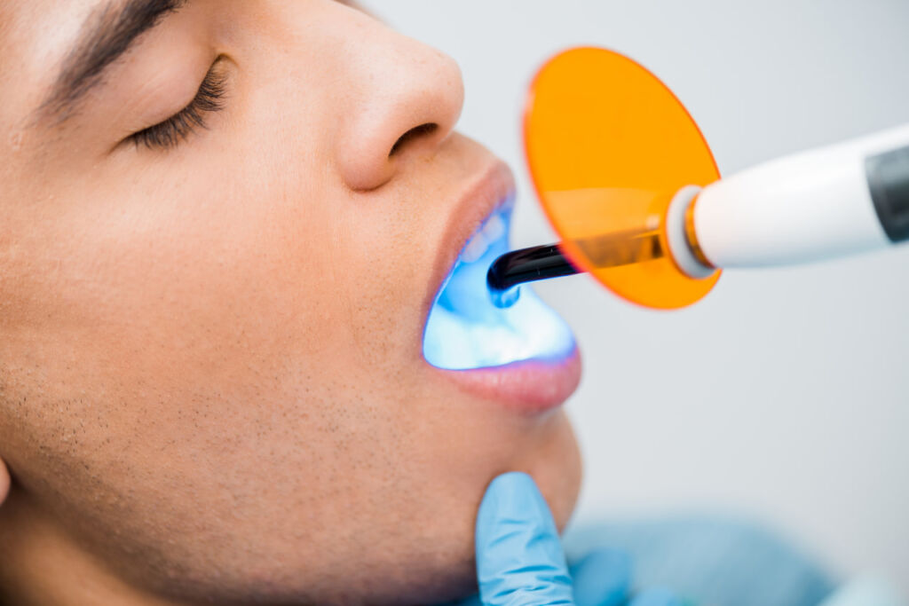 اتجاهات  تجميل الأسنان تبييض الأسنان بالليزر