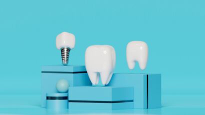 Dental implant illustration for Dental Implant Cost