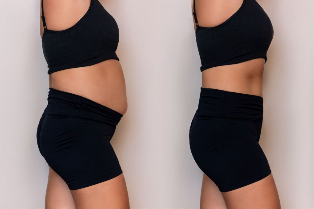 Tummy tuck before/after - side view