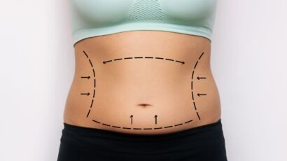 Tummy tuck — abdomen with markings