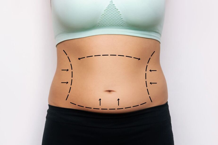 Tummy tuck — abdomen with markings