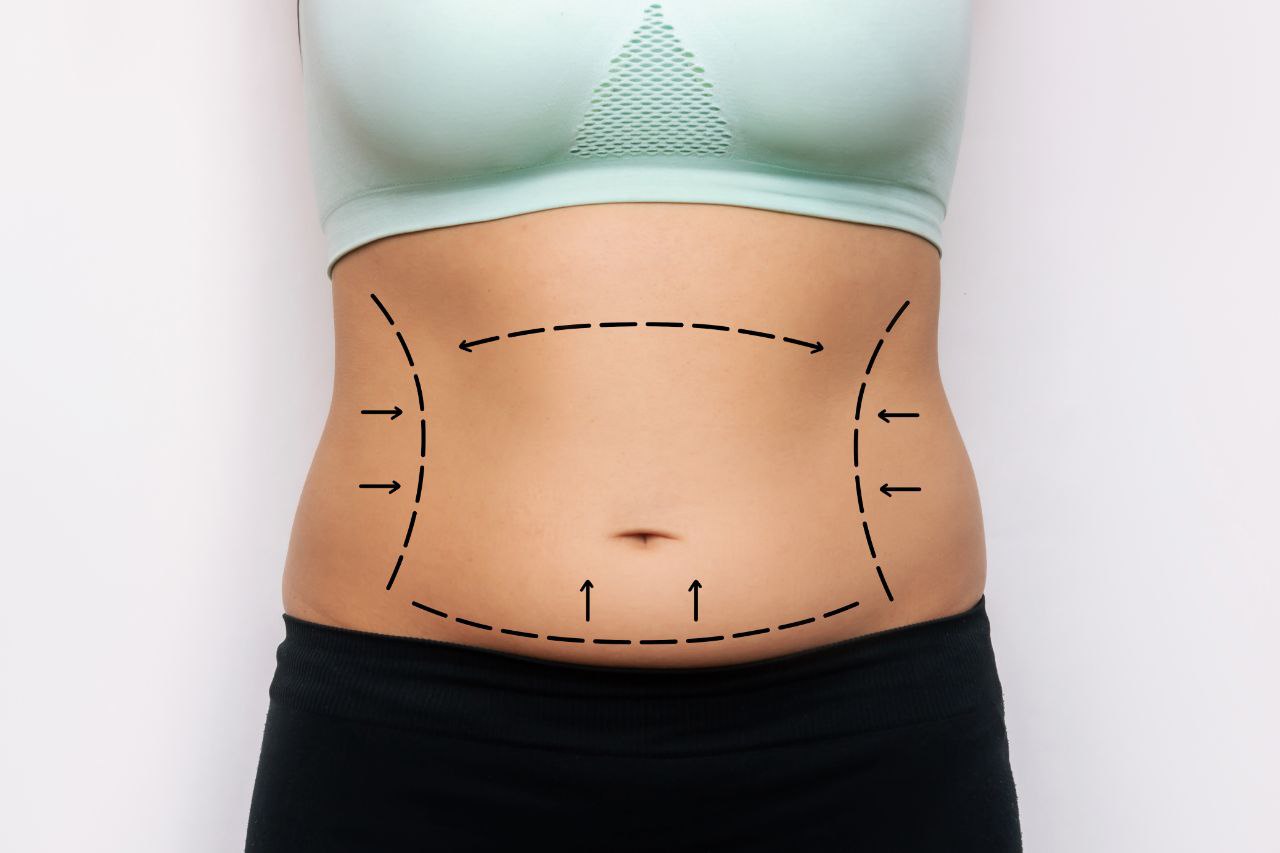 Tummy tuck — abdomen with markings
