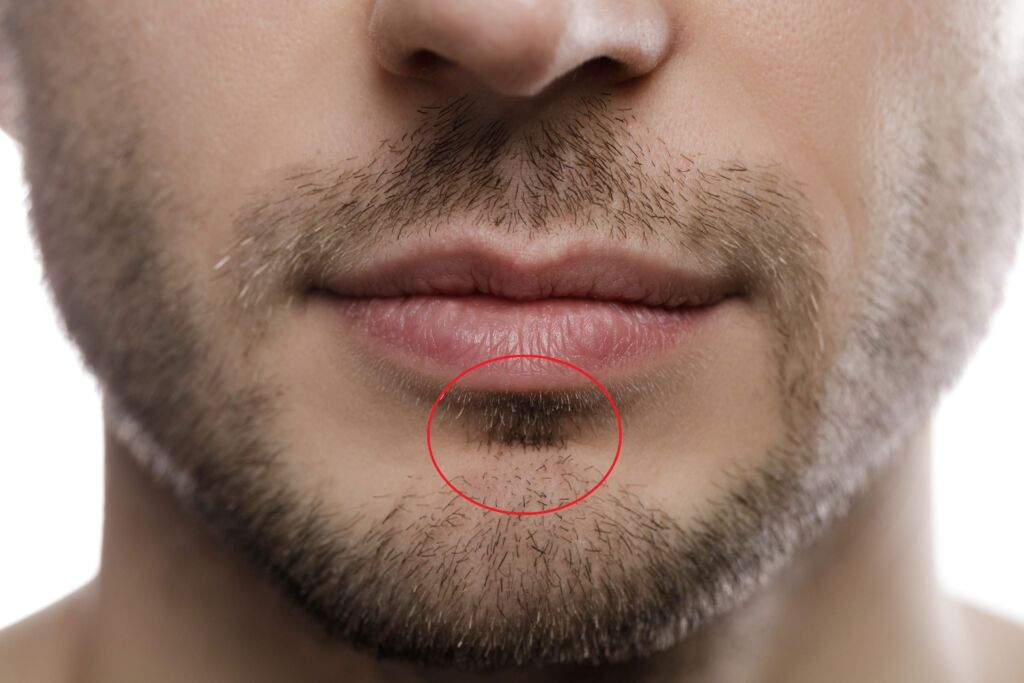 beard transplant turkey soul patch close-up (chin detail)