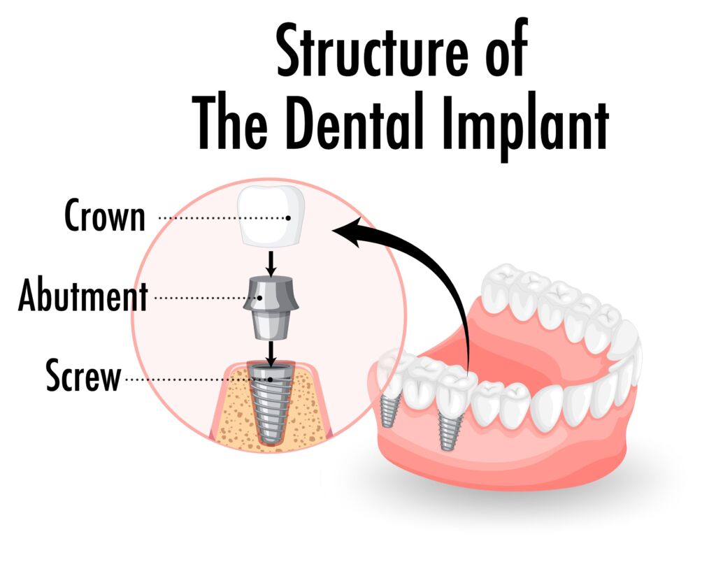 All on 4 Turkey – dental implant with crown and screw 