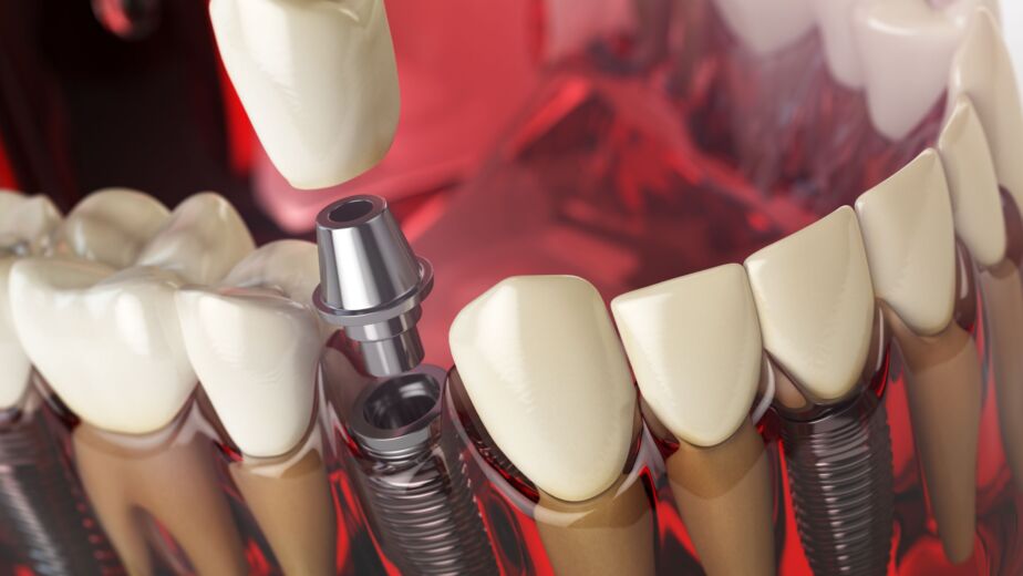 All on 4 Turkey - 3D illustration of a dental implant and crown
