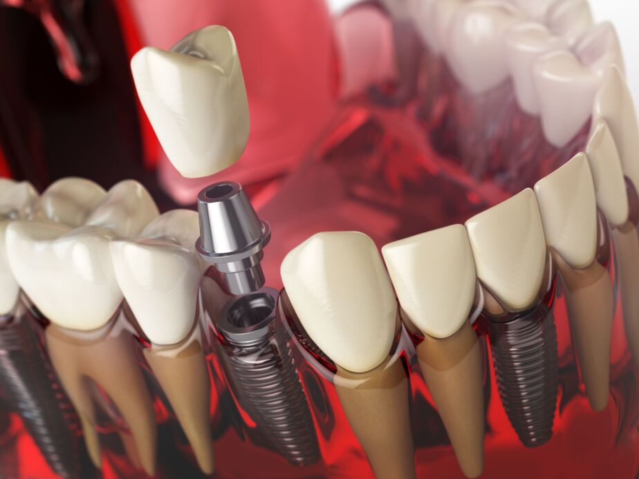 All on 4 Turkey - 3D illustration of a dental implant and crown