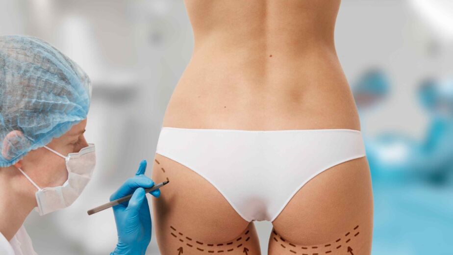 Plastic surgeon marking the buttocks before a Brazilian Butt Lift (BBL) fat transfer procedure.