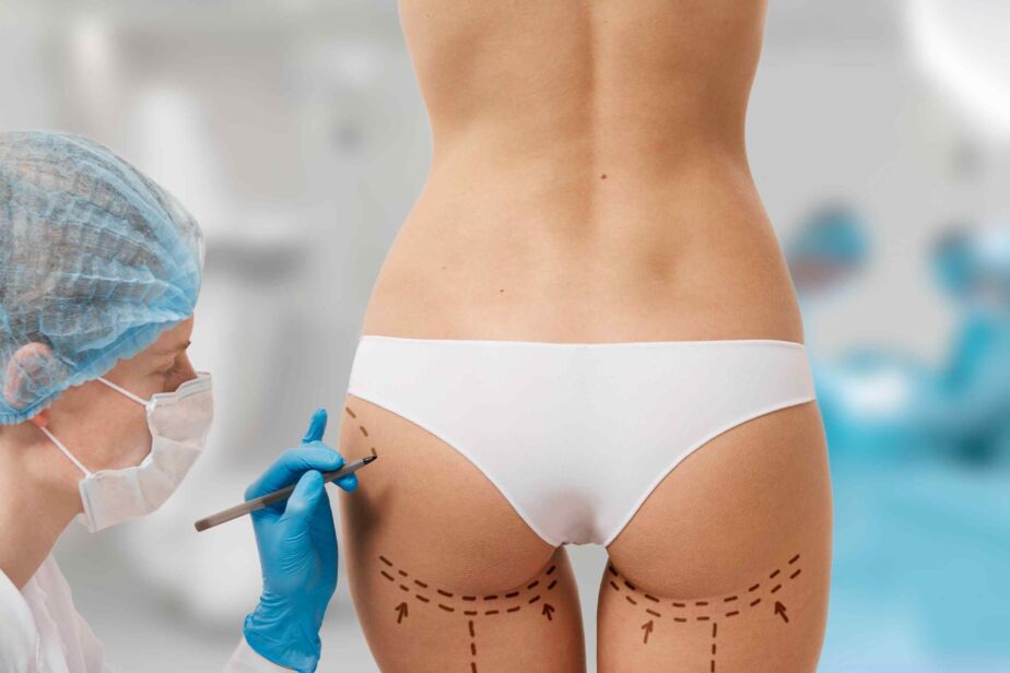Plastic surgeon marking the buttocks before a Brazilian Butt Lift (BBL) fat transfer procedure.