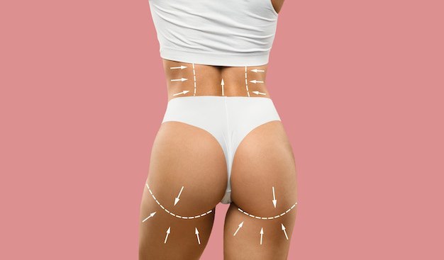 Post-BBL recovery illustration showing liposuction and fat-transfer areas on the waist and buttocks.