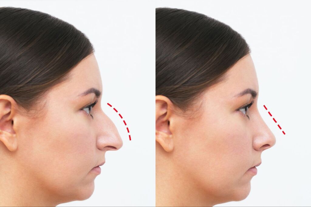 مقارنة جانبية لنتيجة تجميل الأنف تُظهر تنعيم جسر الأنف وتحسين تحديد طرف الأنف.