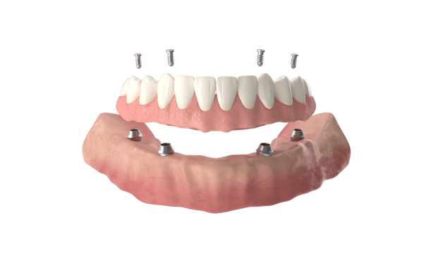 All-on-4 dental implants supporting a full-arch fixed bridge