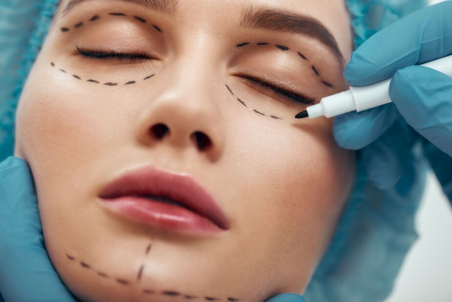 Plastic surgeon marking facial areas before fat transfer to face in Turkey for natural facial rejuvenation