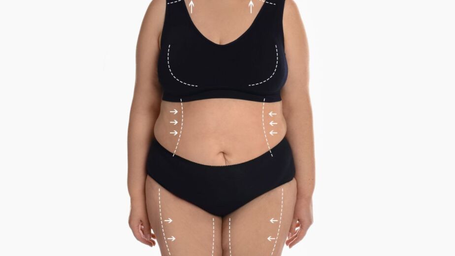 Surgical markings for tummy tuck and waist contouring before a mommy makeover