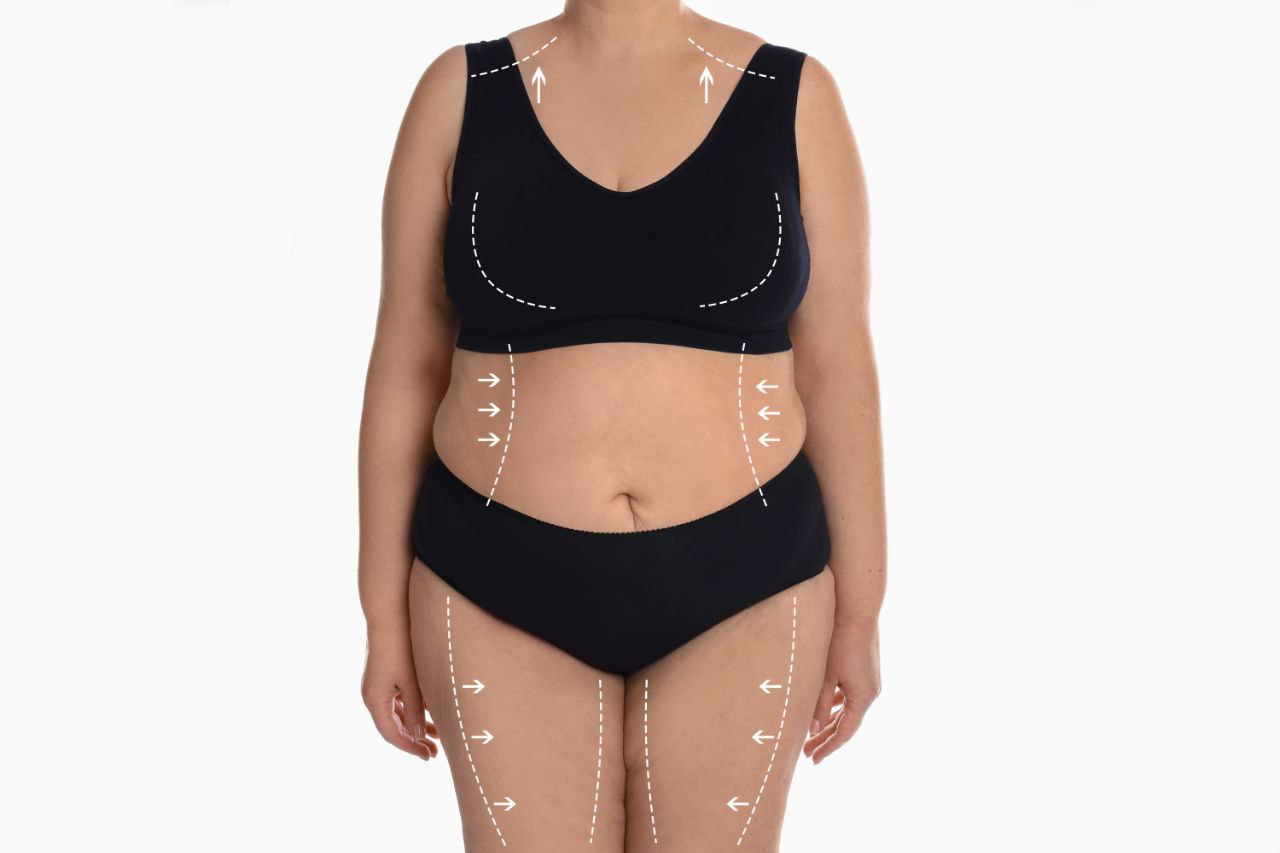 Surgical markings for tummy tuck and waist contouring before a mommy makeover
