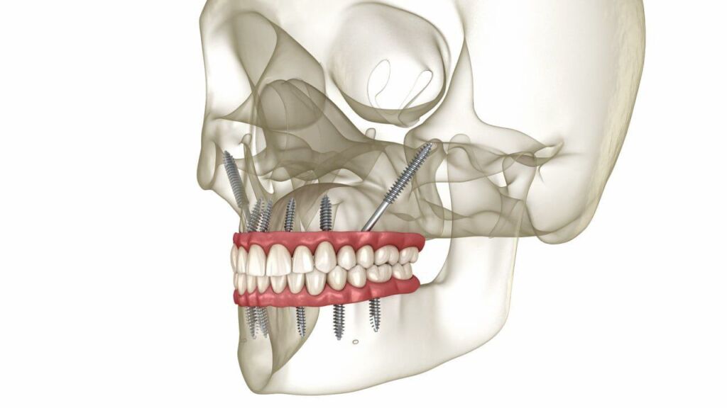 Zygomatic implants anchored in the cheekbone for severe upper jaw bone loss