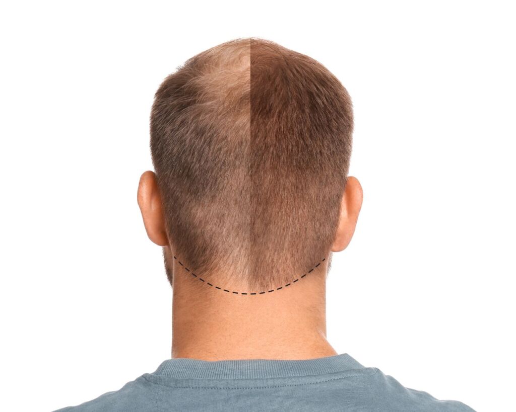 Before and after hair transplant view from the back with donor area marked