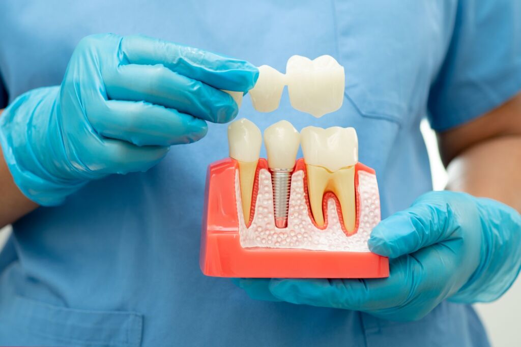 Dental model showing zirconia crowns on prepared and restored teeth during treatment planning for veneers vs crowns
