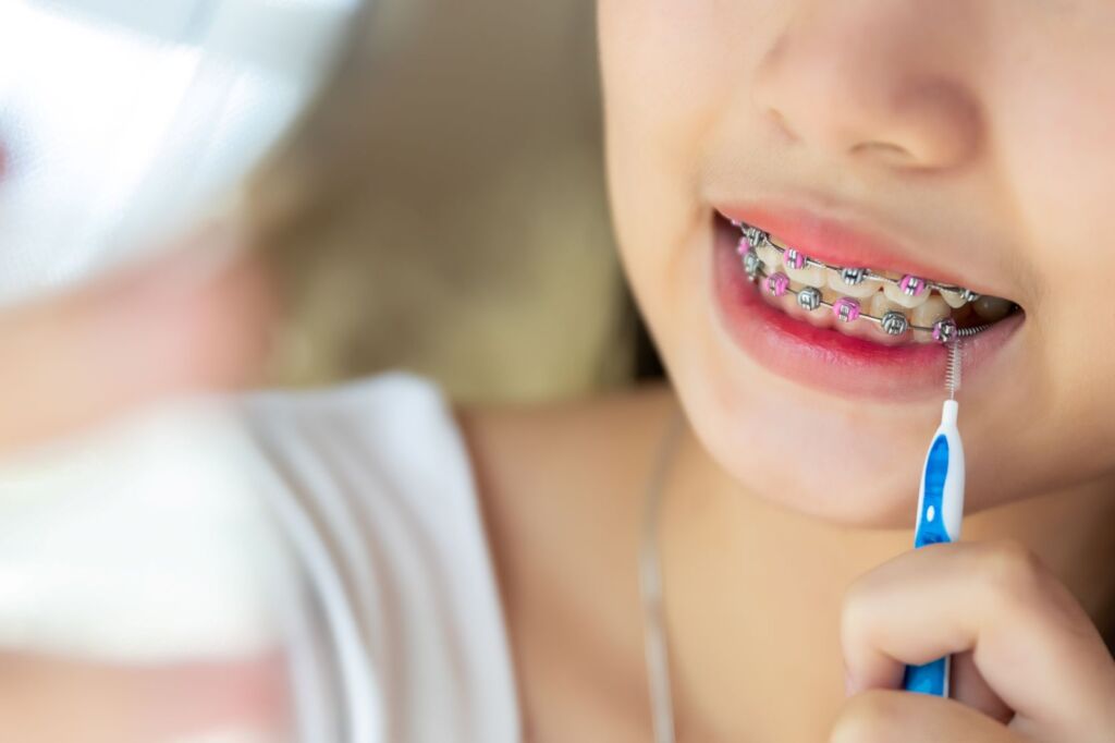 Person cleaning braces with an interdental brush as part of daily orthodontic home care