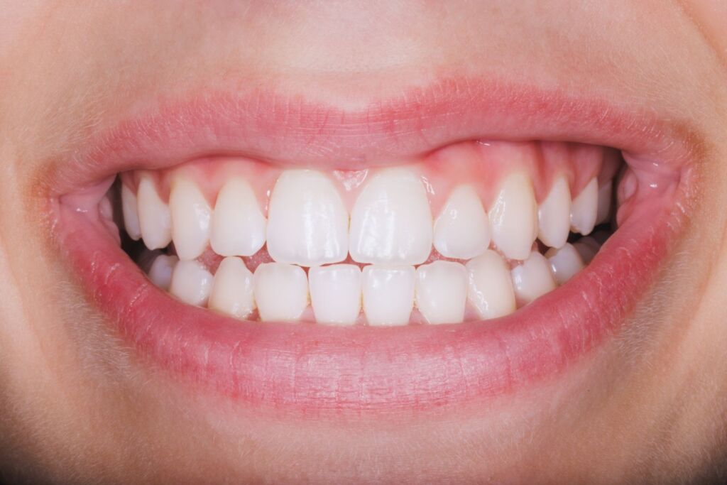 Close-up of a smile showing a crossbite, with misaligned upper and lower teeth