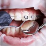 What Is Orthodontic Treatment? Types, Process, and What to Expect