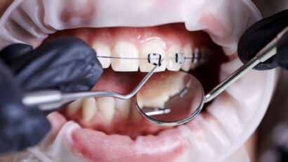 Orthodontist adjusting clear braces during an orthodontic treatment procedure