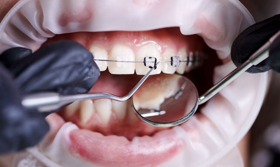 Orthodontist adjusting clear braces during an orthodontic treatment procedure