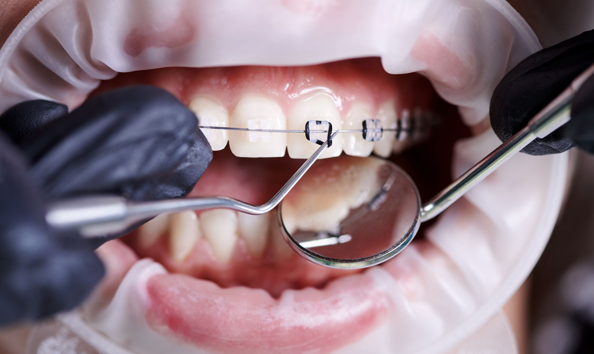 Orthodontist adjusting clear braces during an orthodontic treatment procedure
