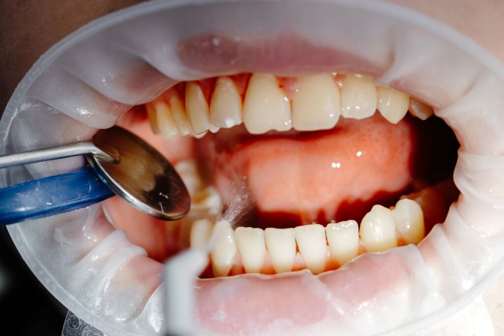 Close-up of bleeding gums during a dental examination
